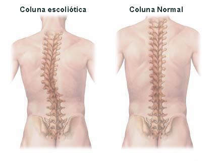 O que é escoliose? Veja sintomas e 4 exercícios posturais, saúde